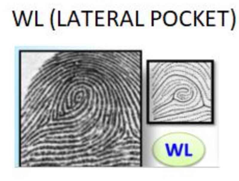 Chủng vân tay Wl- Lateral Pocket
