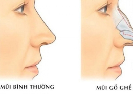 Mũi gồ trong nhân tướng học